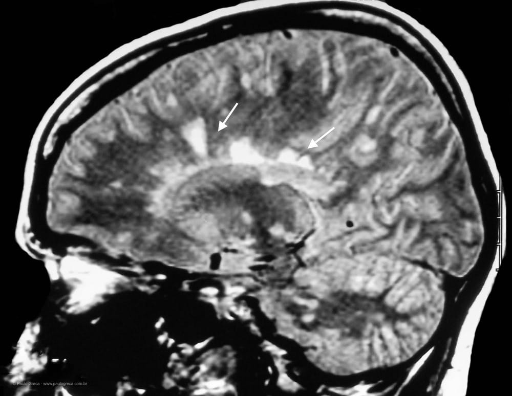 Enxaqueca - Ressonância 2