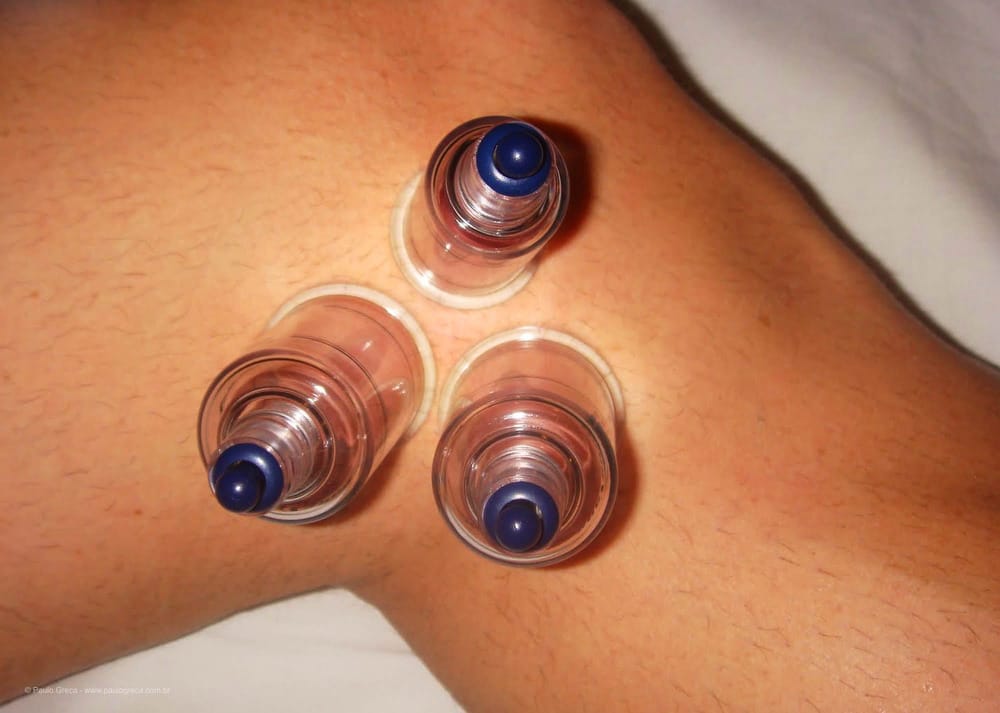 Enxaqueca - Ventosaterapia